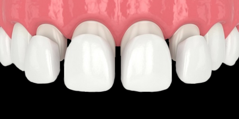 라미네이트 치료 대상