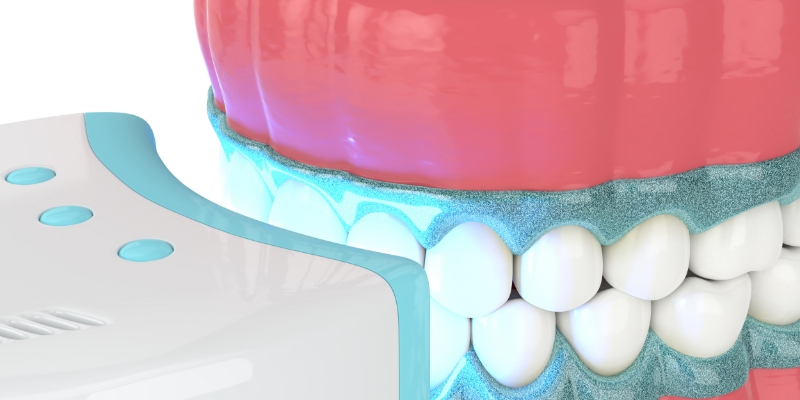 치아미백 치료 대상