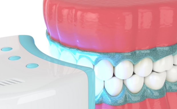 전문가 치아미백