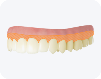 잇몸 보호제 도포