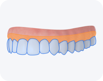 치아 표면 미백제 도포