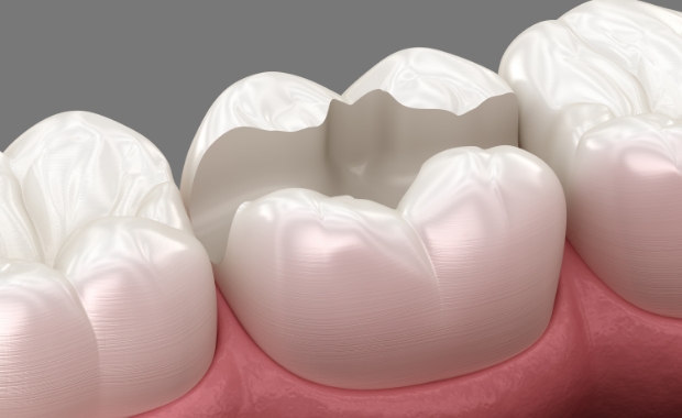 맞춤형 충치치료