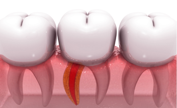 마지막 치료, 신경치료