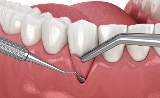 붓고 피나는 잇몸질환