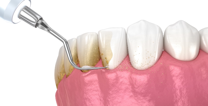 스케일링 (치석제거)
