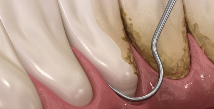 치근활택술 (간단잇몸치료)