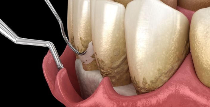치주소파술 (복잡잇몸치료)