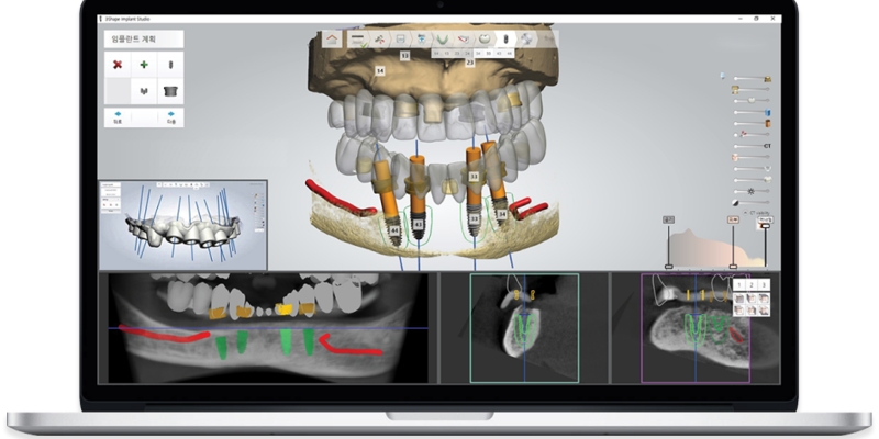 컴퓨터 분석 임플란트